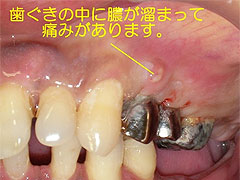 歯の根元の痛み（根管治療）
