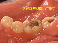 虫歯がある 川崎市 ナチュラ歯科クロスガーデン川崎クリニック