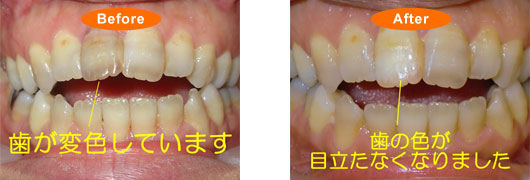 歯の漂白