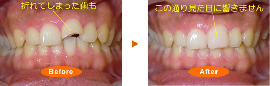 前歯をぶつけて、転んでかけた