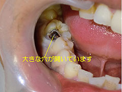 虫歯で痛い