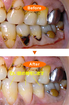 中期の虫歯(C2)(前歯部)