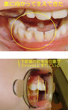 歯並びが悪い