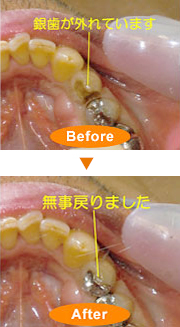 取れたものをつけ直す