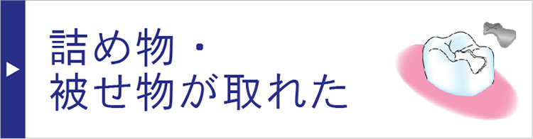 詰め物・被せ物が取れた